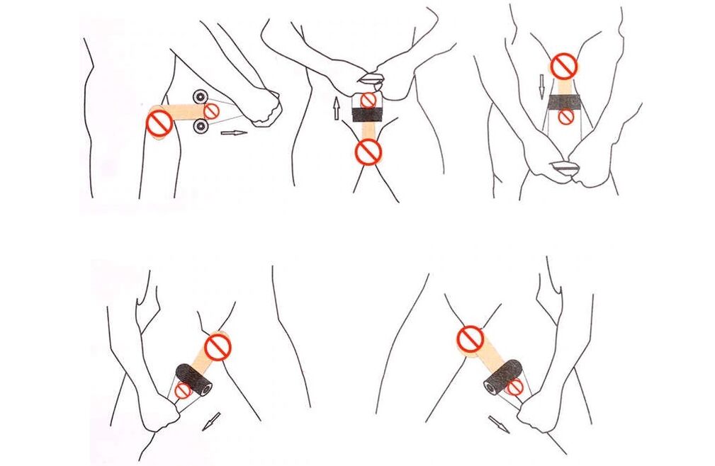 Jelching用于阴茎增大